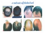 Hair Fall