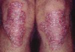 นอไรซิส แคปซูล Noriasis Capsule