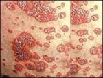 นอไรซิส แคปซูล Noriasis Capsule