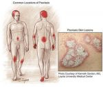 นอไรซิส แคปซูล Noriasis Capsule