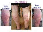 นอไรซิส แคปซูล Noriasis Capsule