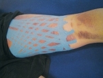 Kinesio Tex Gold คิเนซิโอเท็กซ์โกลด์ ผ้าเทปเพื่อการบำบัด
